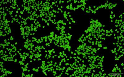 Sjogren’s syndrome related autoimmune encephalopathy presenting as depression and involuntary agitation in a 15-year-old girl: a case report